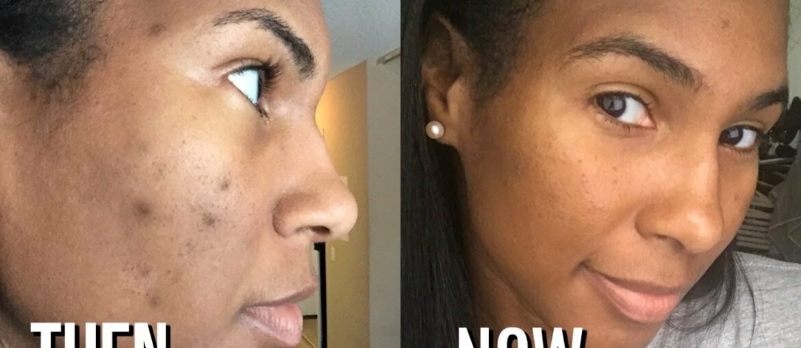 DARK SPOT ROUTINE| HOW TO REMOVE DARK SPOTS ON FACE| VITAMIN C