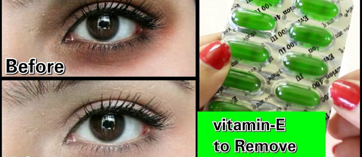 Remove Dark Circles in 3 days with Vitamin- E (100% Works)