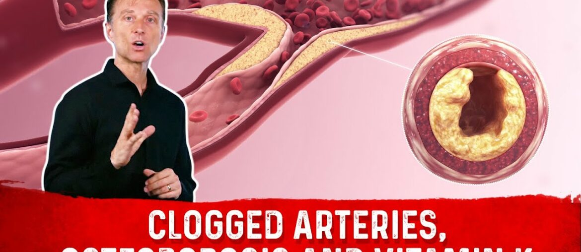 Clogged Arteries, Osteoporosis and Vitamin K2 - Dr. Eric Berg DC