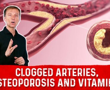 Clogged Arteries, Osteoporosis and Vitamin K2 - Dr. Eric Berg DC