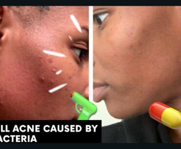 HOW TO GET RID OF ACNE WITH VITAMIN SUPPLEMENTS| I stopped using skincare I wash my face with water