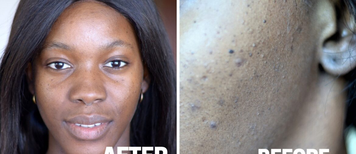 My experience using Vitamin c  and retinol | C20 serum and tretinoin(drug) review