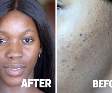 My experience using Vitamin c  and retinol | C20 serum and tretinoin(drug) review