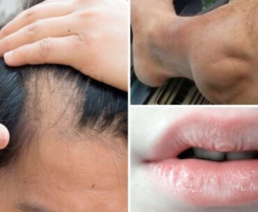 6 Signs You May Have a Vitamin Deficiency