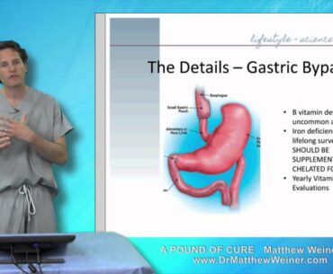 Vitamins after Bariatric Surgery
