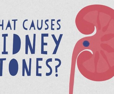What causes kidney stones? - Arash Shadman