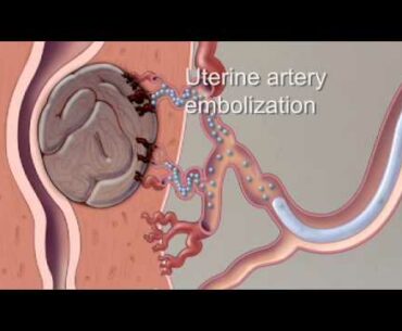 Fibroid Treatment Options - Mayo Clinic