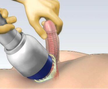 ED1000 - Revolutionary Shockwave Treatment for Erectile Dysfunction