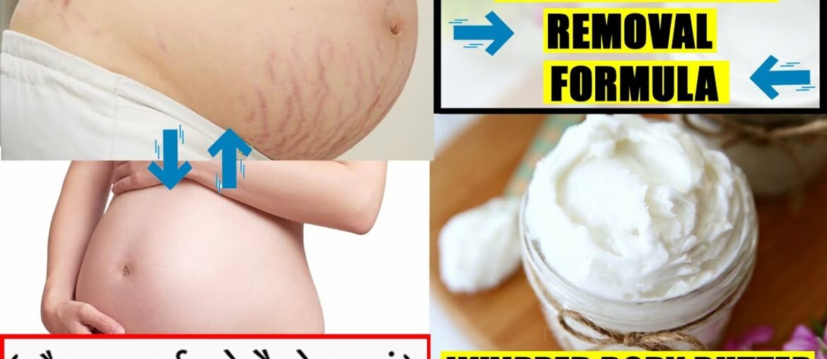 How to remove Stretch Marks | स्ट्रैच मार्क्स को कैसे हटाएं | Wamika Beauty