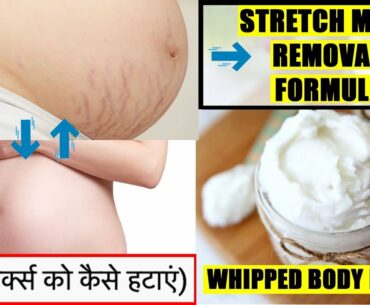 How to remove Stretch Marks | स्ट्रैच मार्क्स को कैसे हटाएं | Wamika Beauty