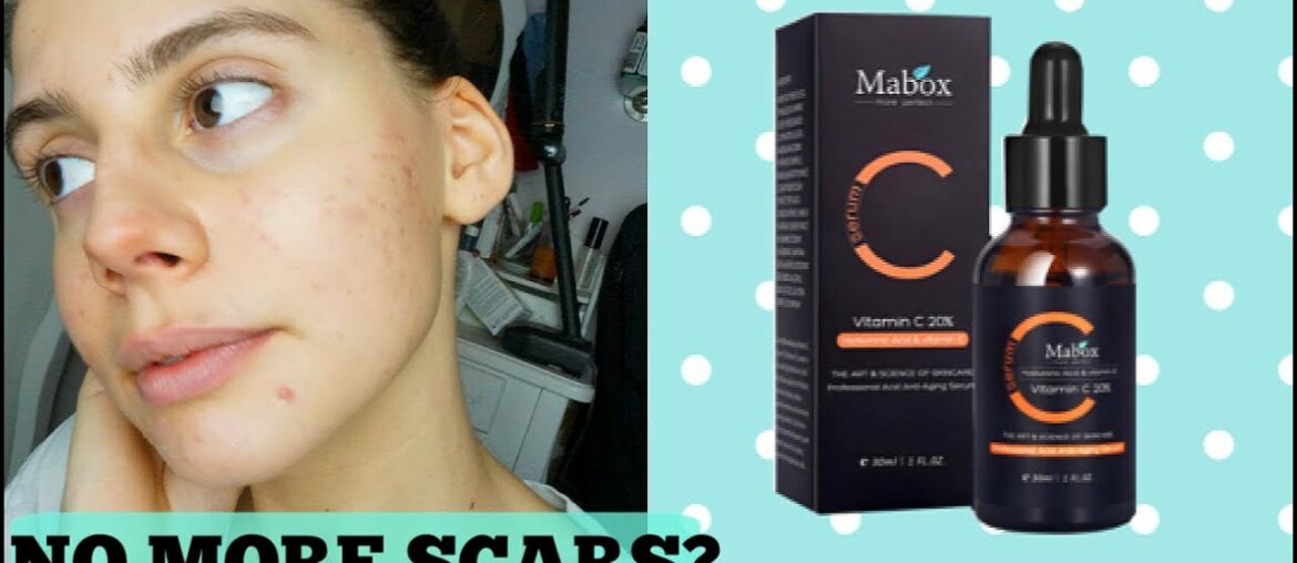 WHAT VITAMIN C DID TO MY ACNE SCARS || Acne Scarring 101