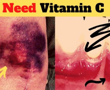 If You Have 11 Signs Then You Need More Vitamin C