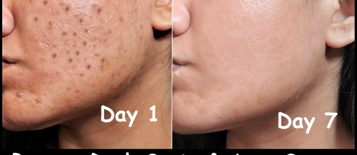 In 7 DAYS - Remove DARK SPOTS, BLACK SPOTS & ACNE SCARS | Orange juice Vitamin C Toner | Open Pores