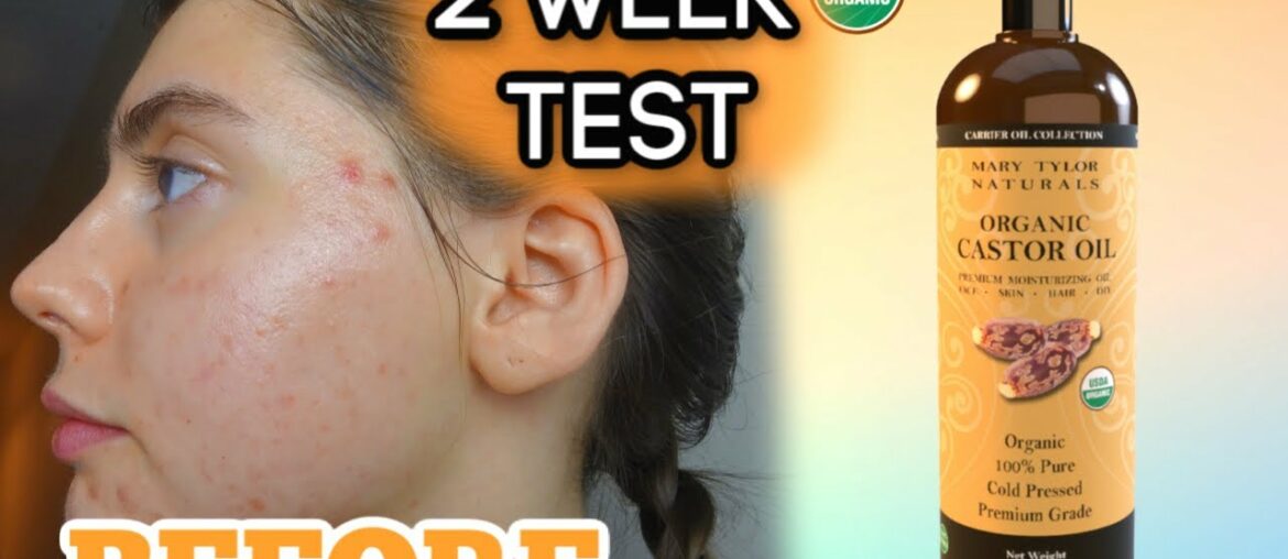 I TESTED PURE CASTOR OIL ON MY FACE FOR MY ACNE SCARS FOR 2 WEEKS || My review and thoughts!