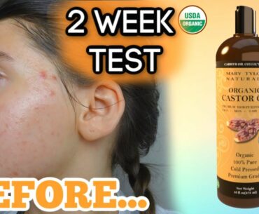 I TESTED PURE CASTOR OIL ON MY FACE FOR MY ACNE SCARS FOR 2 WEEKS || My review and thoughts!