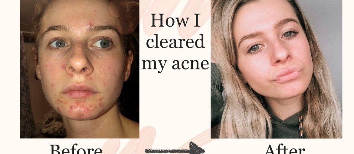 Acne Skin Care Routine | How I cleared my cystic acne|