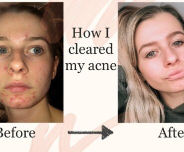 Acne Skin Care Routine | How I cleared my cystic acne|