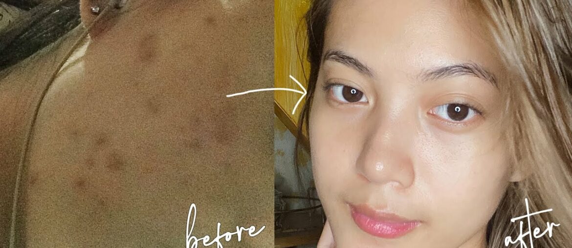 HOW I CLEARED MY SKIN ✨(ACNE JOURNEY + SKINCARE ROUTINE 2020)