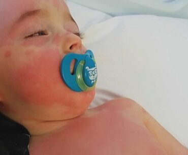 New COVID-19 Symptom Can Cause Inflammation in Children