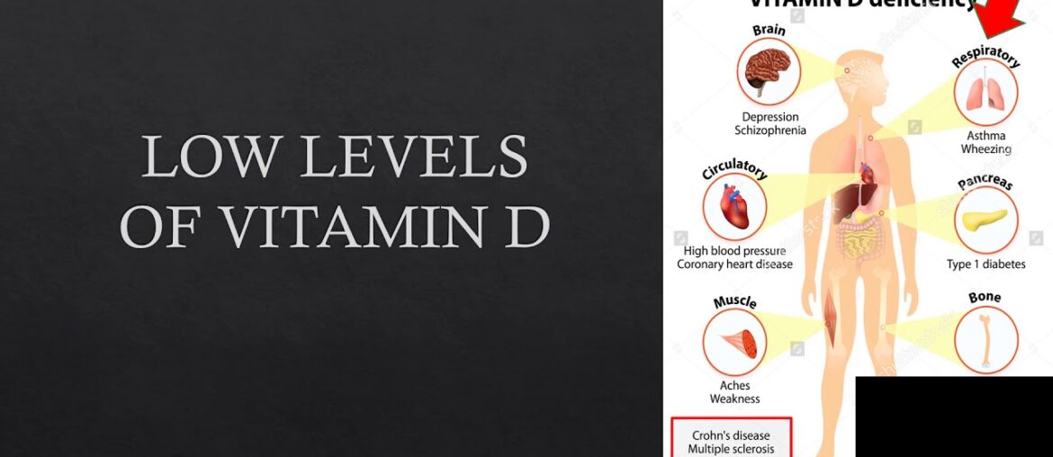 Covid-19 overlooked correlation of Vitamin D levels and severe symptoms