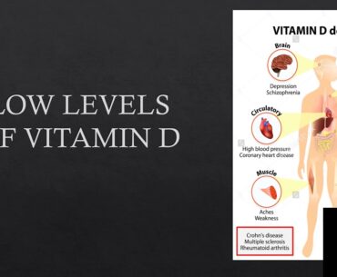Covid-19 overlooked correlation of Vitamin D levels and severe symptoms