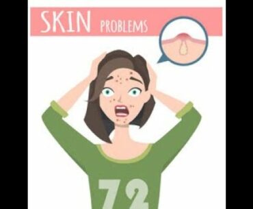 How to win your war against acne ?