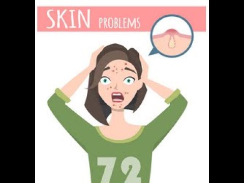 How to win your war against acne ?