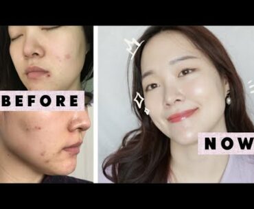 how I'm clearing up my skin. let's keep it this way...