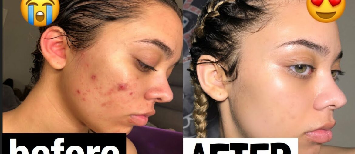 THIS PRODUCT CLEARED MY SKIN IN 2 WEEKS