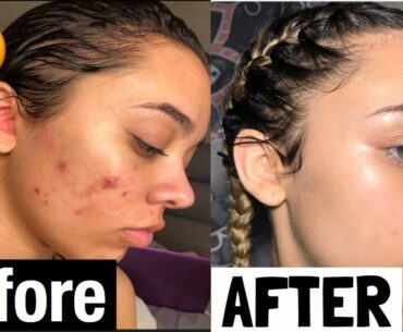 THIS PRODUCT CLEARED MY SKIN IN 2 WEEKS