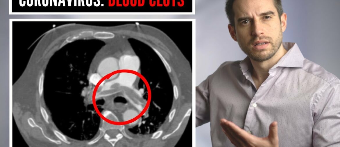 Are BLOOD CLOTS the reason why COVID19 patients are dying? (Blood thinners to save lives?)