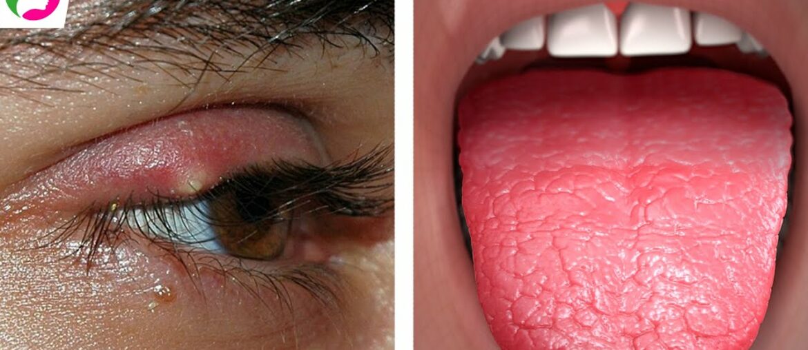 Signs And Symptoms Of Vitamin A Deficiency You Not Ignore