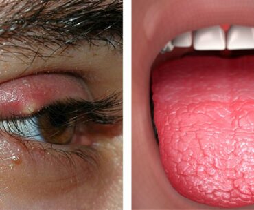 Signs And Symptoms Of Vitamin A Deficiency You Not Ignore