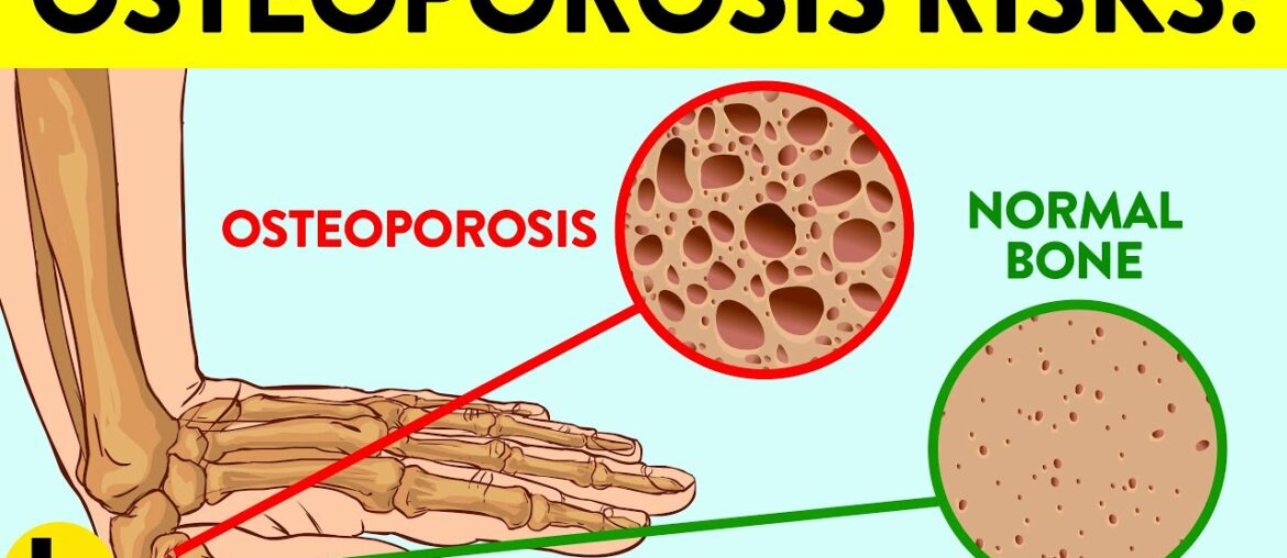 13 Early Warning Signs You’re At Risk For Osteoporosis