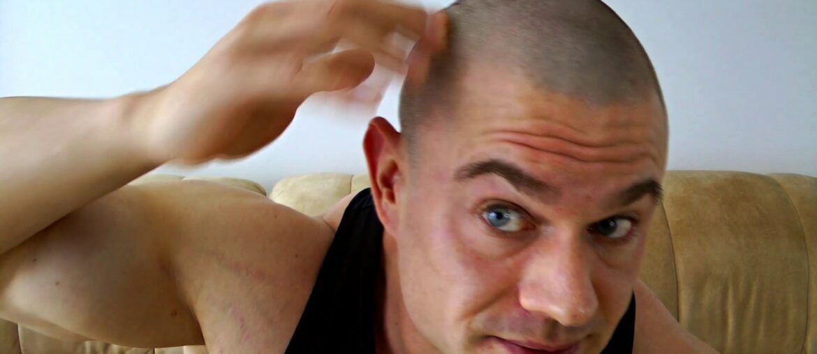 How to Fix Cystic Acne on the Scalp, on Cycle? Anti-Biotics, Vitamin B5, Primrose Oil. Vigorous Q&A