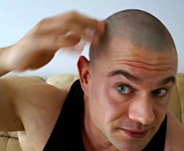 How to Fix Cystic Acne on the Scalp, on Cycle? Anti-Biotics, Vitamin B5, Primrose Oil. Vigorous Q&A