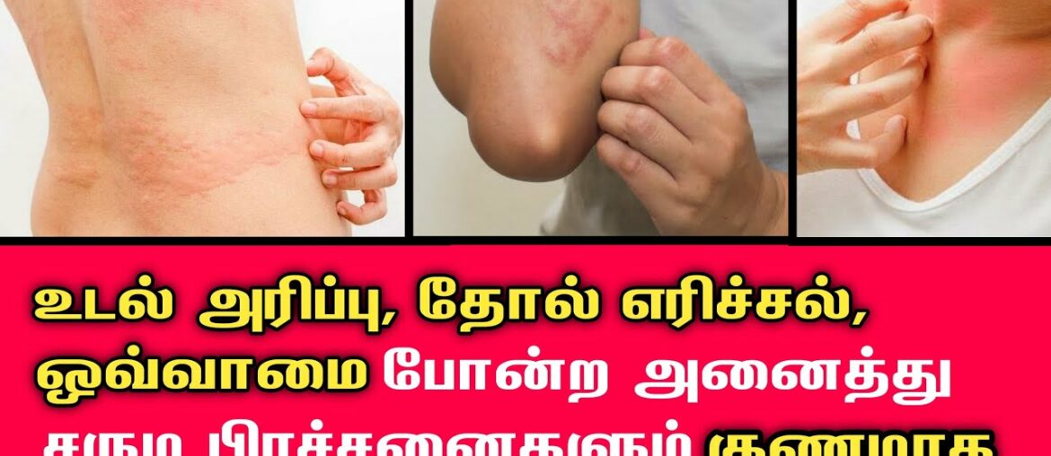 தோல் அரிப்பு, சொறி, அலர்ஜி, சோரியாசிஸ்,தடிப்பு, போன்ற தோல் நோய்கள் எளிதில் குணமாக வீட்டு மருத்துவம்