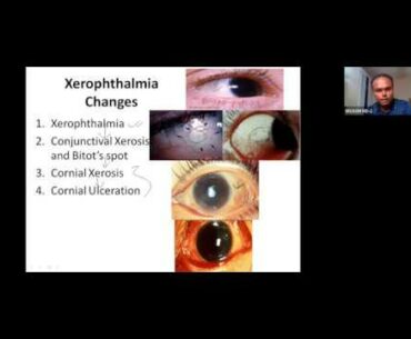Fat soluble Vitamins and USMLE style questions discussion on Vitamins