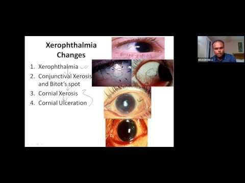 Fat soluble Vitamins and USMLE style questions discussion on Vitamins