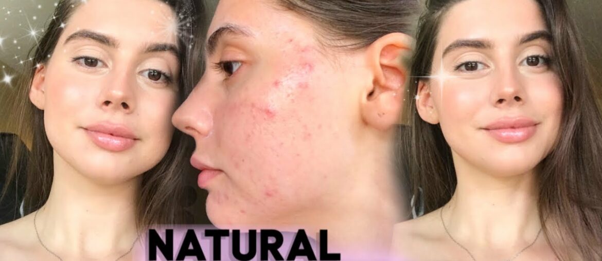 HOW TO COVER UP ACNE NATURALLY W/ MAKEUP || GOLDEN HOUR with acne Tutorial , UPDATED MAKEUP ROUTINE!