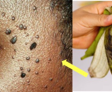 REMOVE SKIN TAGS & MOLES OVERNIGHT WITH BANANA PEEL ((TWO WAYS))
