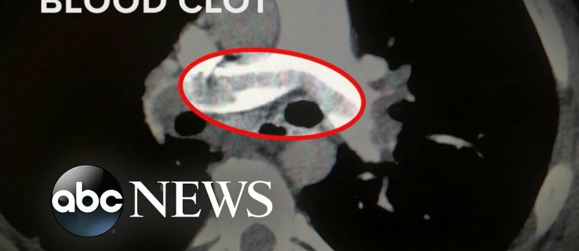 High number of COVID-19 patients have blood clots | WNT