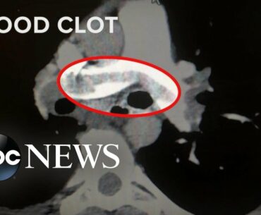 High number of COVID-19 patients have blood clots | WNT
