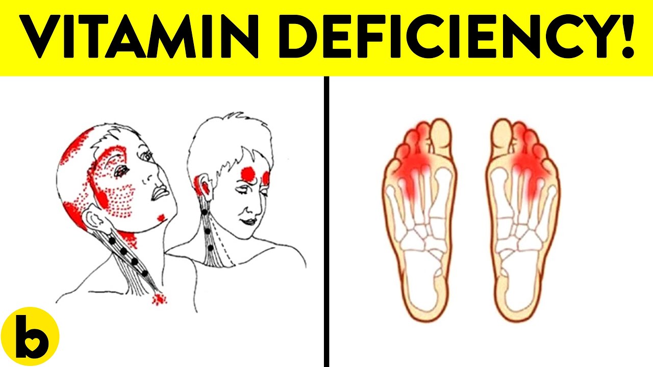 Vitamin B12 Deficiency Symptoms That Should Never Be Ignored