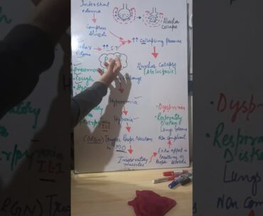 Immune system: Pathophysiology of COVID-19 part 2 by Irfan sir