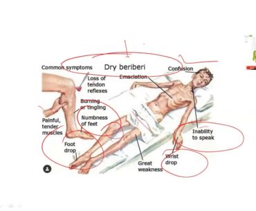 Vitamin B1 ( thiamine ) | Beriberi | Wernicke Korsakoff syndrome