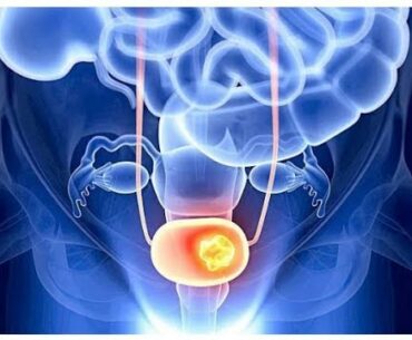 Vitamin D Ke Kami Masani Ke Cancer Ka Hatra Barh Sakta hai