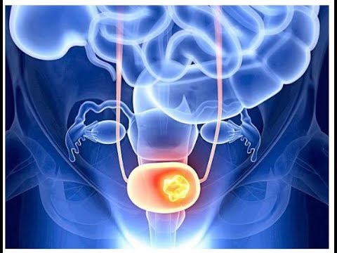 Vitamin D Ke Kami Masani Ke Cancer Ka Hatra Barh Sakta hai