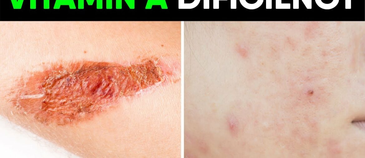 7 Hidden Signs of Vitamin A Deficiency You Should Not Ignore