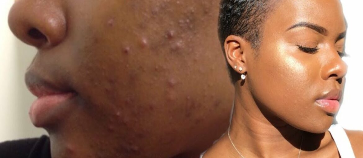 GET RID OF ACNE FAST WITH THESE TWO VITAMINS! |  Nia Hope